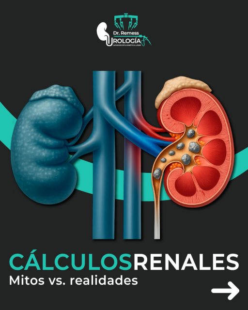 💧 Los cálculos renales están rodeados de muchos mitos, pero conocer la realidad es clave para prevenir y tratarlos correctamente.
👉 Infórmate y toma decisiones con base en hechos, no en creencias.