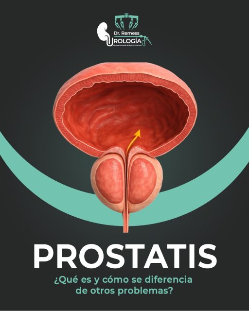 🔍 ¿Sabías que la prostatitis puede confundirse con otros problemas?
Es una inflamación que afecta a muchos hombres, y aunque puede ocurrir a cualquier edad, detectarla a tiempo es fundamental para un tratamiento adecuado.
👉 Si sientes molestias, no dudes en enviarme un mensaje. Estoy aquí para ayudarte.
